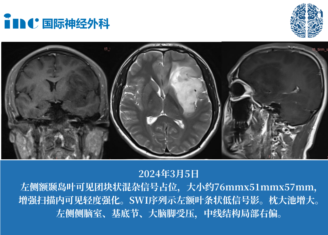 左側(cè)島葉巨大占位，考慮膠質(zhì)瘤，卻被告知手術(shù)風(fēng)險(xiǎn)很大，有偏癱，失語(yǔ)風(fēng)險(xiǎn)。