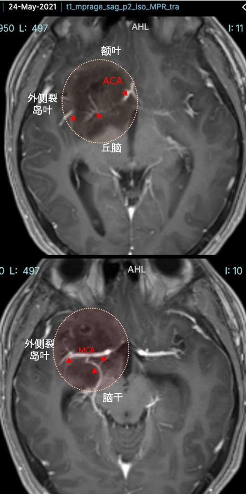 腫瘤血管豐富包裹大腦前動(dòng)脈、大腦中動(dòng)脈及其分支等