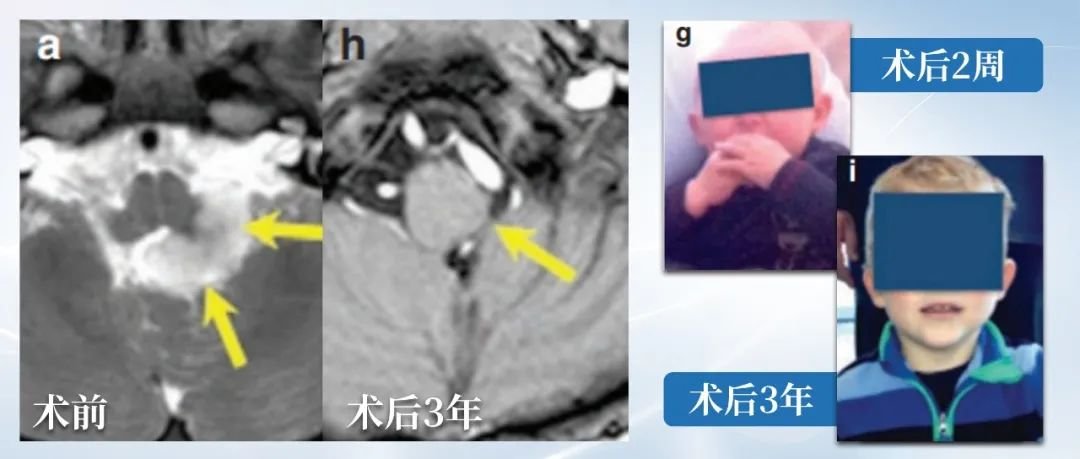 經(jīng)過一場全切手術(shù)，小Nick得以”絕處逢生“，術(shù)后3年復(fù)查核磁未見腫瘤復(fù)發(fā)