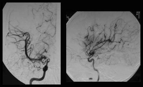 當(dāng)?shù)蒯t(yī)生為真由進(jìn)行磁共振成像（MRI）和磁共振血管造影（MRA），判斷真由得了煙霧病，Suzuki期為II期或介于II期和III期之間的過渡期。