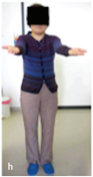 術(shù)后11年隨訪，腫瘤無復(fù)發(fā)。術(shù)后她沒有任何癥狀，享受著正常人的生活。