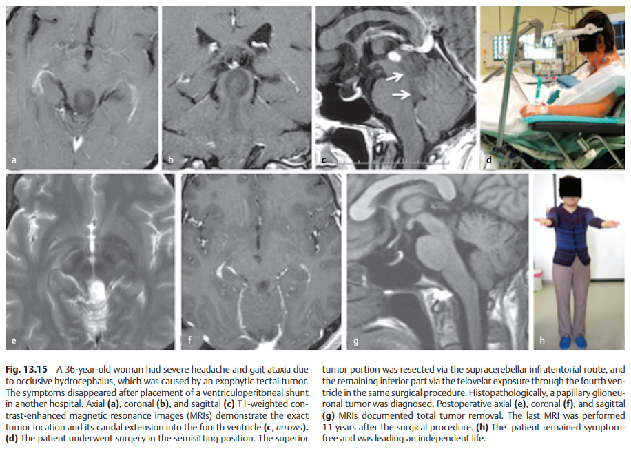 該案例來源于2020年新版的世界腦干手術(shù)專著《Surgery of the Brainstem》（腦干手術(shù)）中，巴特朗菲教授撰寫的《adult brainstem glioma》（成人腦干膠質(zhì)瘤）章節(jié)。