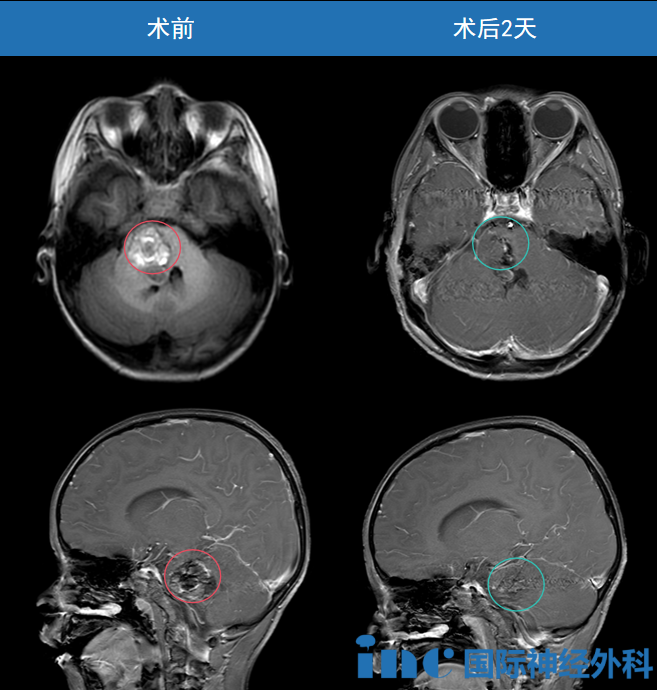 幸運的是，在得到巴教授全切手術后，淼淼重拾活力。而且用他更加頑強的生命力，努力生長著……
