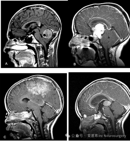 圖1：不同腦區(qū)小兒腦腫瘤的矢狀位 MRI。(A) 14 歲男性后顱窩腫瘤，有惡心、嘔吐和頭痛病史。手術(shù)時(shí)，病變證明是髓母細(xì)胞瘤。(B) 10 歲女性中線鞍上占位性病變伴內(nèi)陷至第 3 腦室，伴有進(jìn)行性視力喪失和頭痛。這個(gè)腫瘤是顱咽管瘤。(C) 2 歲女性矢狀旁腫瘤，有短暫的<a href='/dianxian/' target='_blank'><u>癲癇</u></a>發(fā)作和腿部無力病史。這個(gè)腫瘤是室管膜母細(xì)胞瘤。(D) 有嘔吐和頭痛病史的 2 歲男性第三腦室后方腫瘤。病變?yōu)樗晒w母細(xì)胞瘤。