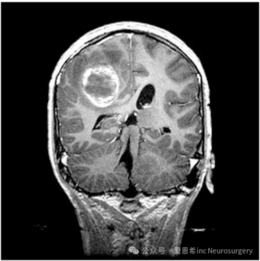 圖3：對(duì) 14 歲男性 1 型神經(jīng)纖維瘤病進(jìn)行冠狀 MRI 掃描，表現(xiàn)為突然發(fā)作的頭痛。MRI 顯示出血和腫瘤，并被證明是膠質(zhì)母細(xì)胞瘤多形式手術(shù)。