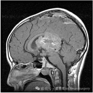 圖5：14 歲男性腦室內(nèi)室管膜瘤矢狀 MRI，表現(xiàn)為頭痛和記憶喪失的簡短病史。