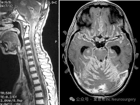 圖6：播散性髓母細(xì)胞瘤的 MRI。（A） 在該矢狀面 MRI 上可以看到脊髓有腫瘤覆蓋。（B） 顯示大腦的彌漫性軟腦膜播種。