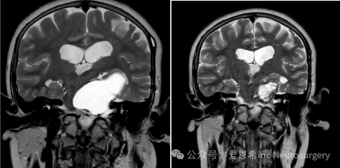 圖7：囊性顱咽管瘤用 Ommaya 儲(chǔ)液器和反復(fù)敲擊保守治療。冠狀位 MRI 掃描顯示 (A) 插入 Ommaya 儲(chǔ)液器之前和 (B) 插入 Ommaya 儲(chǔ)液器之后和重復(fù)敲擊后;顯示囊腫大小顯著減小。