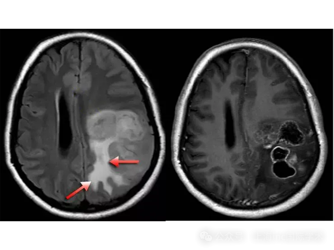 FLAIR序列腫瘤為稍高信號，腫瘤周圍白質內見不規(guī)則形高信號水腫，勾勒出局部腦白質形態(tài)，水腫呈指套樣伸向白質。