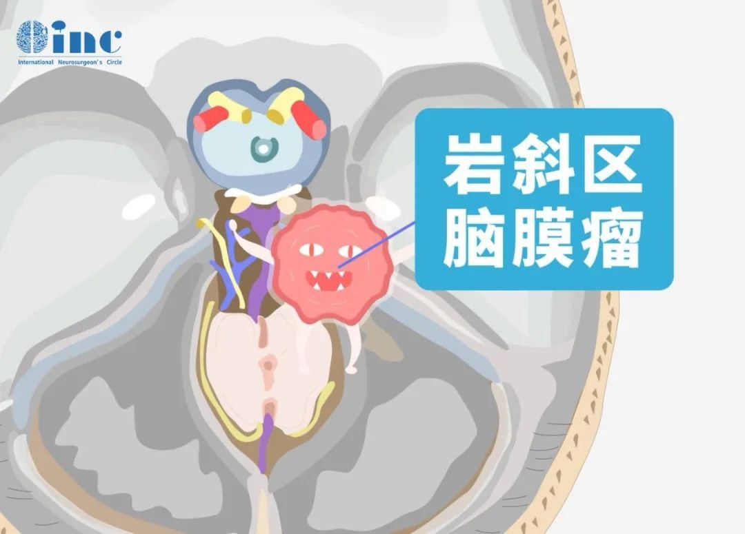 巖斜區(qū)腦膜瘤