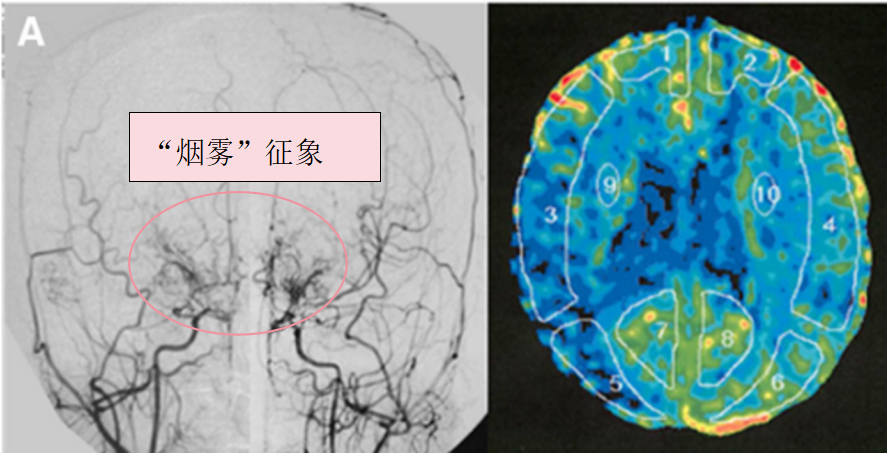 當(dāng)煙霧病合并甲亢，先治哪邊？國(guó)際神外專家破解治療困局