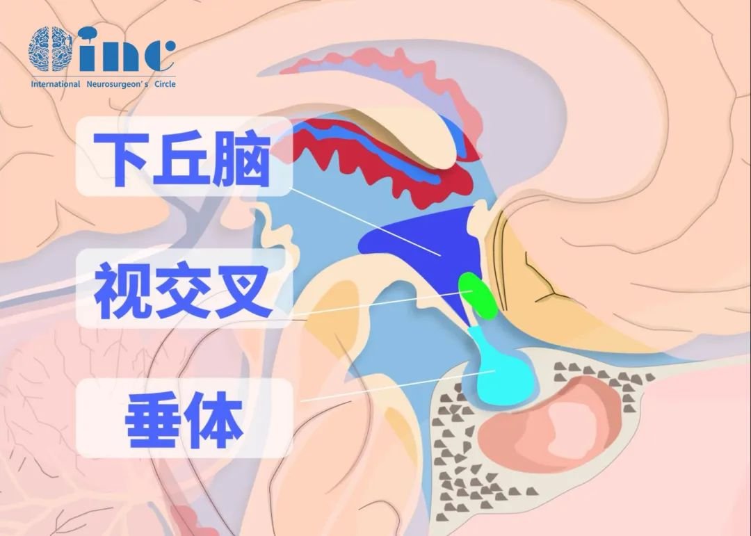 INC專家顱咽管瘤手術(shù)案例實(shí)證放棄開顱手術(shù)選擇經(jīng)鼻入路