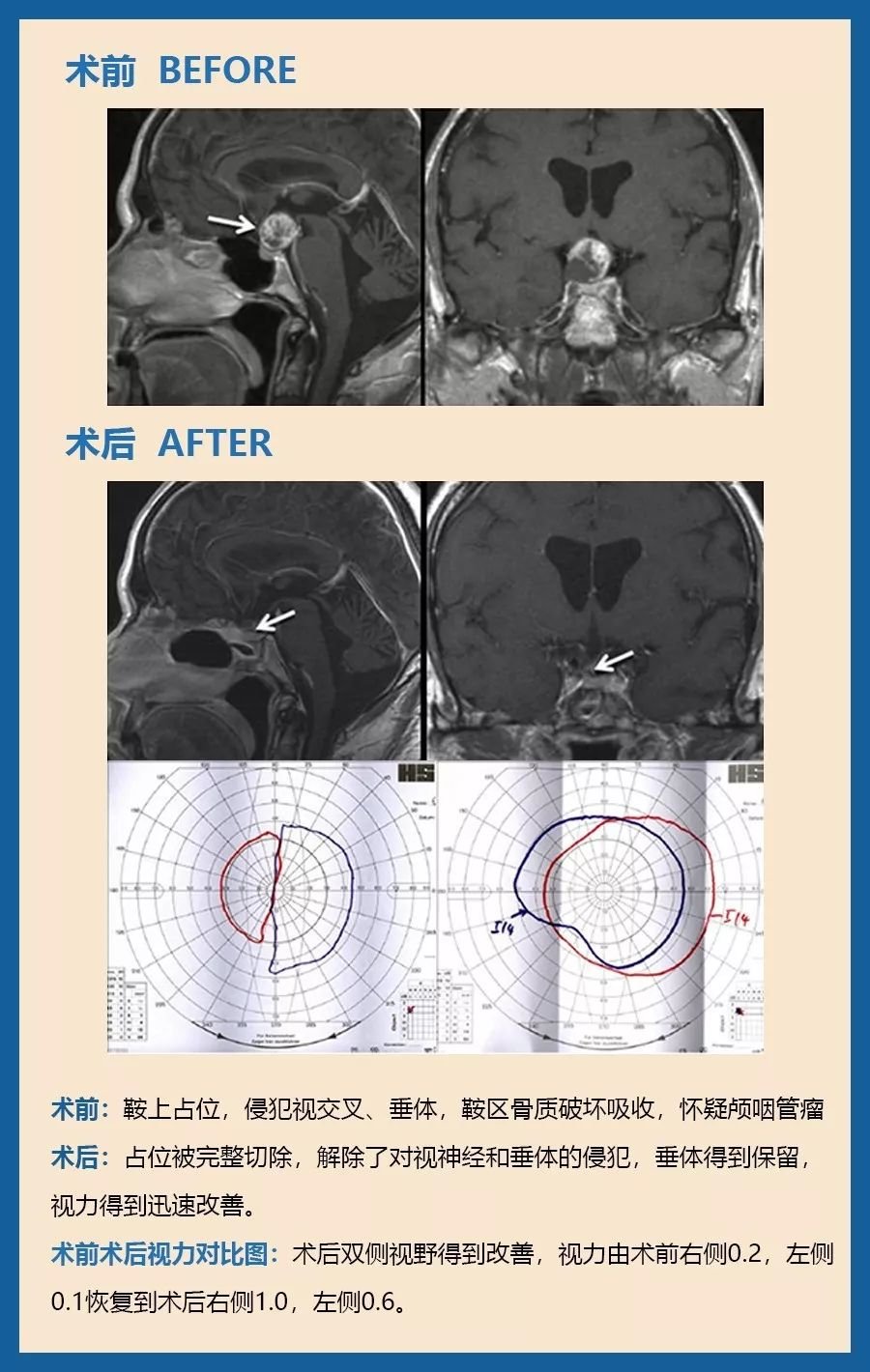 57歲，高度視力喪失、視野受限，顱咽管瘤。眼科檢查顯示左側(cè)0.1和右側(cè)0.2的視力以及高級(jí)雙時(shí)間偏盲。