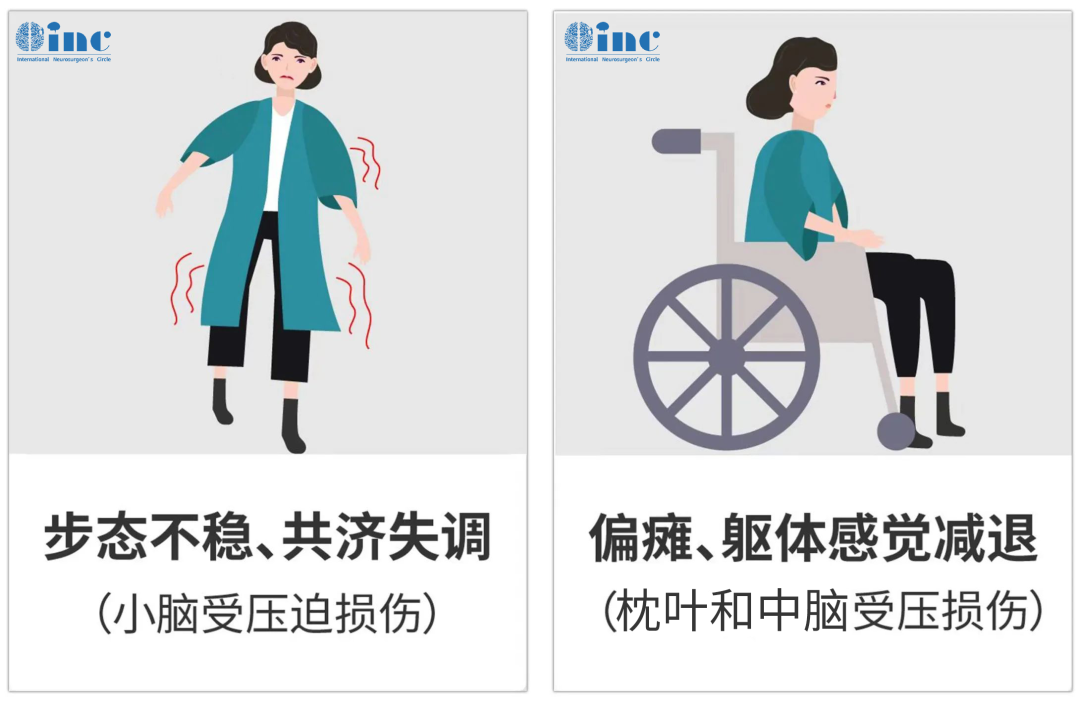 被保留下來的腦膜瘤隨著時(shí)間流逝，會(huì)慢慢長大，向下生長壓迫小腦，會(huì)走路不穩(wěn)、共濟(jì)失調(diào)。