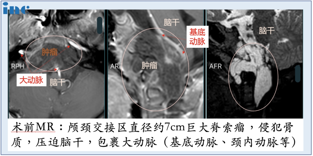 腫瘤位置特殊，體積巨大，明顯壓迫腦干，林林在國內(nèi)接受了第一次手術(shù)，部分減少腫瘤的體積。