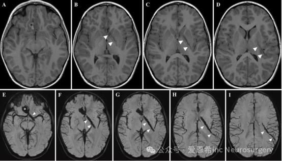 圖3.軸位T1加權(quán)MRI(A-D)和磁敏感加權(quán)成像(E-I)顯示右額葉基底腦實(shí)質(zhì)出血(星號(hào))，并伴有從血腫后方延伸至左側(cè)顳葉的線性軌跡(箭頭)，該軌跡經(jīng)過(guò)胼胝體膝部、左側(cè)蒼白球、內(nèi)囊前肢和左側(cè)后部島葉。這與穿透右側(cè)眼眶的損傷一致。
