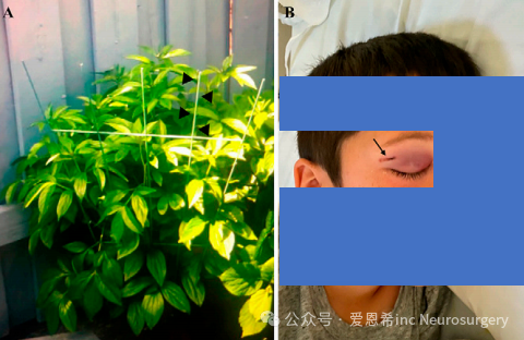 圖1. 照片顯示了導(dǎo)致創(chuàng)傷的物體，即花園尖樁(箭頭，A)，該尖樁穿透了患者的右側(cè)眼眶，患者出現(xiàn)了瘀傷、眼周腫脹以及右眉下方的擦傷(箭頭)，這些跡象表明了花園尖樁的入口點(diǎn)(B)。