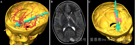 圖4.使用BrainLAB規(guī)劃軟件對(duì)患者頭骨及損傷軌跡進(jìn)行三維（3D）重建。旋轉(zhuǎn)圖像顯示了穿透物軌跡、帶有入口點(diǎn)的眼眶以及繞過(guò)的腦內(nèi)血管之間的三維解剖關(guān)聯(lián)（A）。軸位T2加權(quán)MRI顯示左側(cè)內(nèi)囊（紅色輪廓，B），指示穿透性創(chuàng)傷軌跡與其后肢的相對(duì)位置。血性產(chǎn)物涉及胼胝體膝部和后肢的前部，也可在內(nèi)囊后肢附近看到（B），并有額外的三維重建圖（C）。