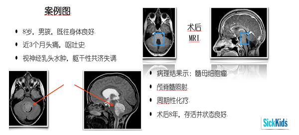 Rutka教授為Andre實施了個體化綜合治療：手術切除聯(lián)合術后放療、周期性化療。該方案顯示顯著成效，患兒實現(xiàn)了八年無進展生存，更保持著良好的神經(jīng)認知功能。