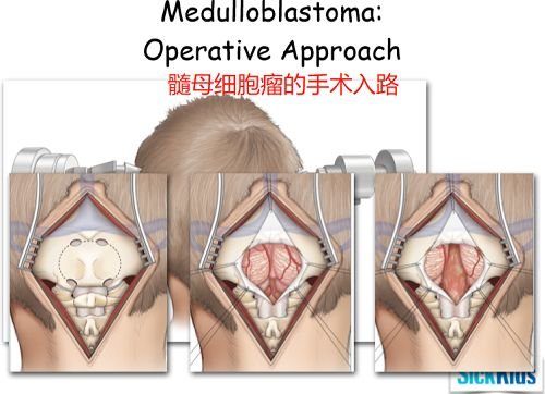 任何手術都要保證安全性，盡量不對大腦功能造成損傷。