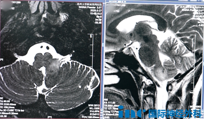 湯女士的腫瘤長(zhǎng)在腦干延髓上，其內(nèi)含有心跳、呼吸、消化等基本生命中樞。解剖關(guān)系復(fù)雜、位置深、遍布重要神經(jīng)血管等，手術(shù)難度很高