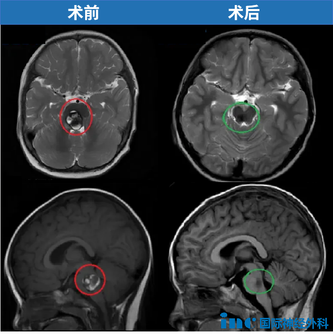 2歲，聰聰，腦干-腦橋海綿狀血管瘤，2019年巴教授中國(guó)示范手術(shù)，順利全切腫瘤，目前已經(jīng)在上小學(xué)。
