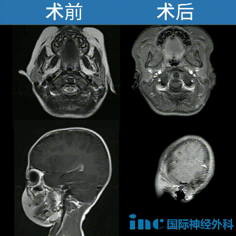 3歲，浩浩，腦干膠質(zhì)瘤，體重只有16kg，對(duì)手術(shù)和出血的耐受力極差。巴教授主刀，于北京天壇醫(yī)院成功手術(shù)。