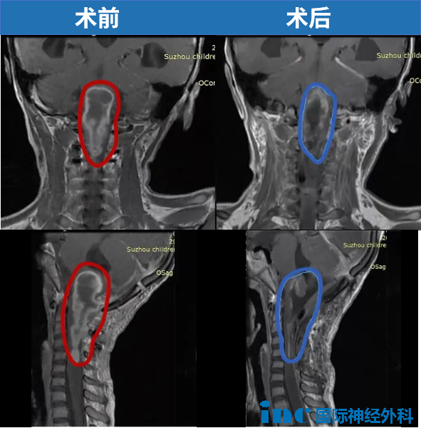 6歲，琦琦，腦干延髓，一直延伸至頸5節(jié)段脊髓，巴教授中國(guó)示范手術(shù)，腫瘤幾近全切。術(shù)后3年，琦琦可以像正常孩子一樣玩耍。
