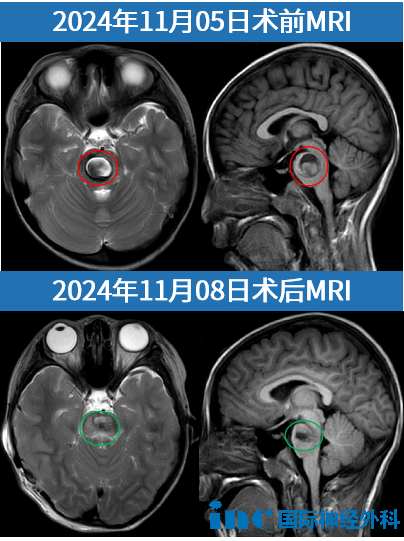 7歲女孩萌萌，腦干海綿狀血管瘤突發(fā)出血，120緊急轉(zhuǎn)運(yùn)至蘇州大學(xué)附屬兒童醫(yī)院，巴教授順利全切血管畸形。短短2天時(shí)間，從發(fā)病到成功手術(shù)……