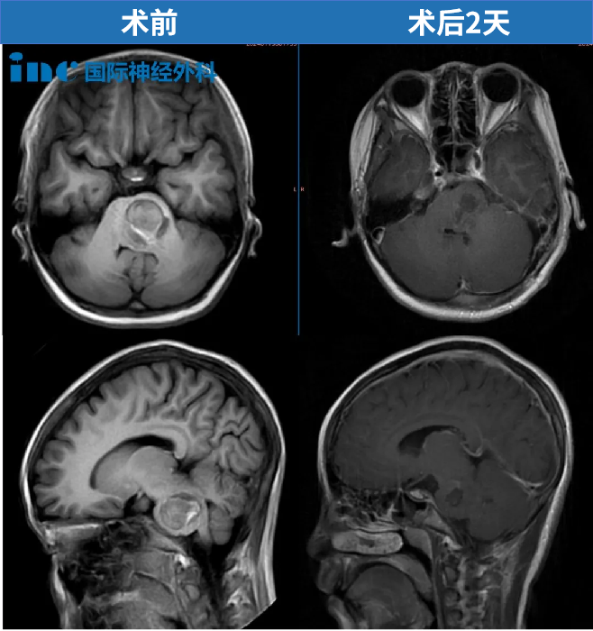 11歲，貝貝，腦干海綿狀血管瘤出血，120急救送進(jìn)ICU、病情危急，2024年巴教授為其成功示范手術(shù)，目前已回歸校園。