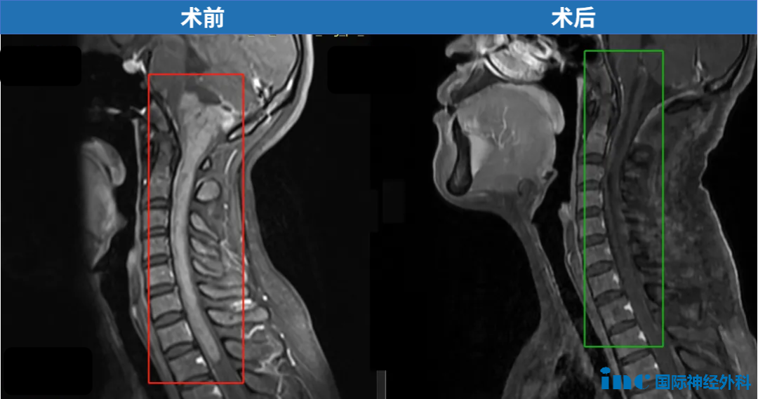 33歲，鄭女士，15cm腫瘤起源于腦干下部，累及延髓和顱頸交界區(qū)，且向下方延伸到整個(gè)頸部脊髓以及一直到第一胸椎水平，巴教授成功示范手術(shù)。
