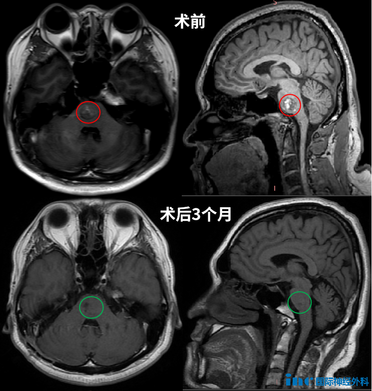39歲杜先生，腦干(橋腦)海綿狀血管瘤2次出血，坐輪椅跨省1000公里求醫(yī)。巴教授成功手術(shù)后，目前已回歸正常工作和生活。