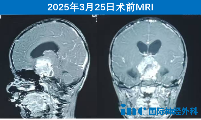 在蘇州大學(xué)附屬兒童醫(yī)院，“神奇”的巴爺爺又為一名年僅5歲的視路膠質(zhì)瘤患兒守護(hù)光明，讓幼小的生命得以繼續(xù)探索這絢爛春光！