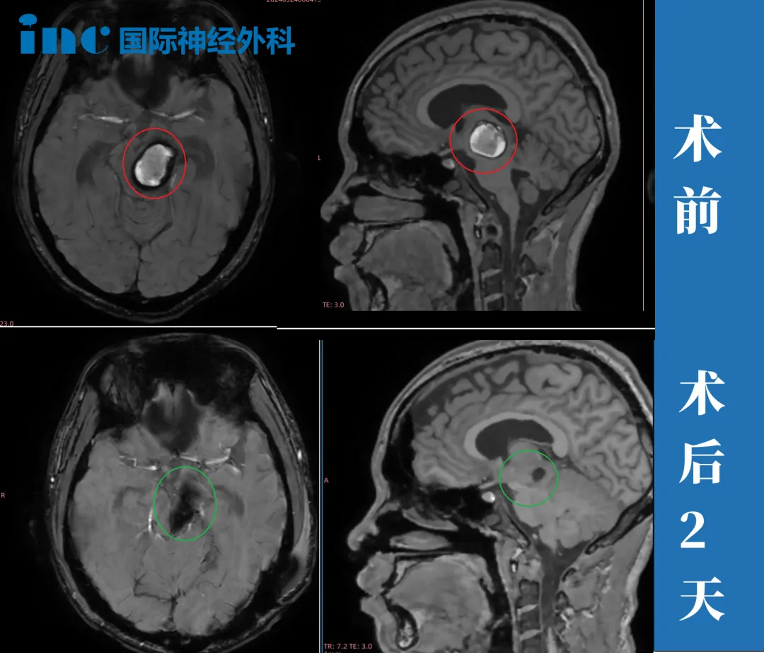 術前術后MRI影像