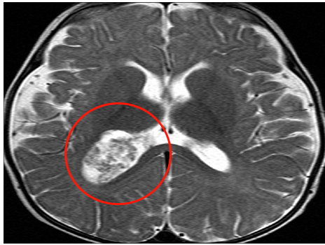 在SickKids，磁共振成像(MRI)顯示，Oliver右側(cè)腦室后角有一個大腫塊，考慮脈絡(luò)叢乳頭狀瘤病變，并有蒂連接，伴有中度腦積水。