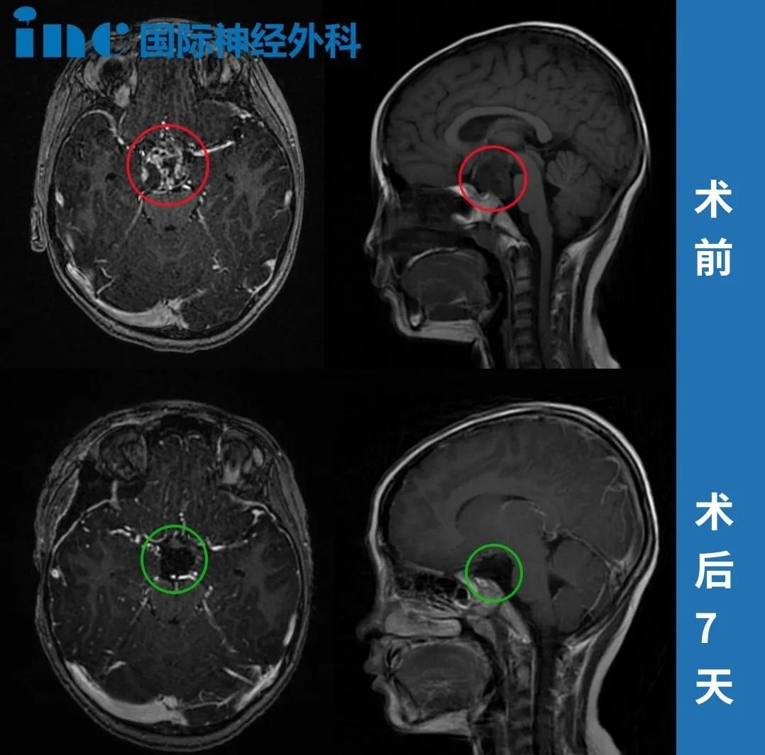 目前小迪情況穩(wěn)定，后續(xù)需定期隨訪。