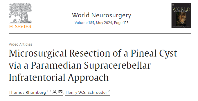 施羅德教授所發(fā)表的論文《Microsurgical Resection of a Pineal Cyst via a Paramedian Supracerebellar Infratentorial Approach》(通過旁中線幕下小腦上入路顯微手術(shù)切除松果體囊腫)