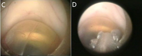 C，囊腫的內(nèi)鏡視圖  D，用腱膜鉗打開囊腫