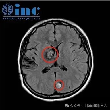在做過核磁檢查之后，發(fā)現(xiàn)原本在右側基底節(jié)的病灶變大了，并且出現(xiàn)了新的出血在左頂葉枕區(qū)。