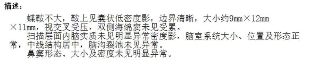 2024年開始，又開始出現(xiàn)視力下降，視野缺損。眼科檢查發(fā)現(xiàn)，左眼視力為0.05.右眼視力為0.3.
