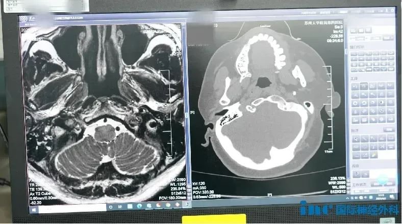 被頸靜脈孔區(qū)隱蔽腫瘤折磨多時，如今的她“一天比一天好”!