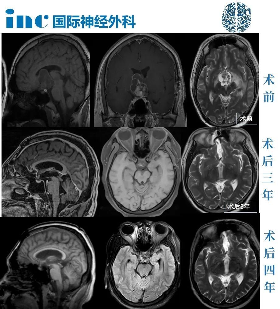 病理報(bào)告兩度反轉(zhuǎn)35歲壯年遭遇顱咽管瘤