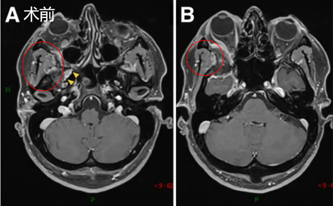 41歲男性蝶眶腦膜瘤侵襲翼腭窩，成功全切