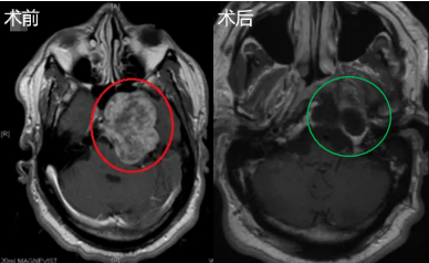 51歲男性軟骨瘤侵襲海綿竇，成功全切