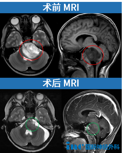 MRI影像
