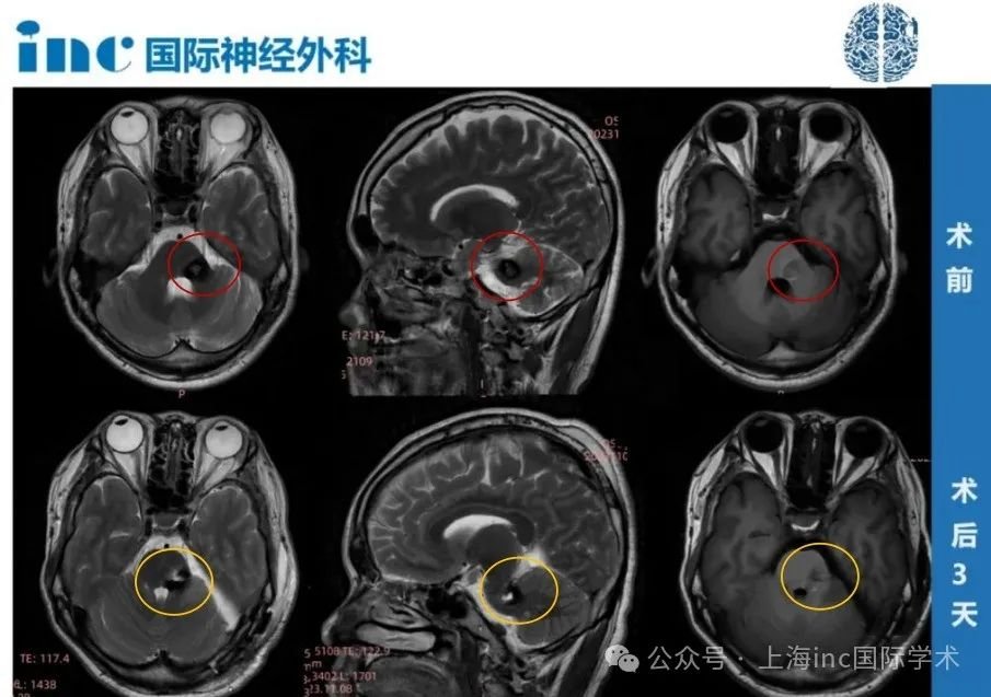 術(shù)后第1天，盧先生就從ICU，轉(zhuǎn)入普通病房，術(shù)前他所擔(dān)心的面癱也都沒有發(fā)生。