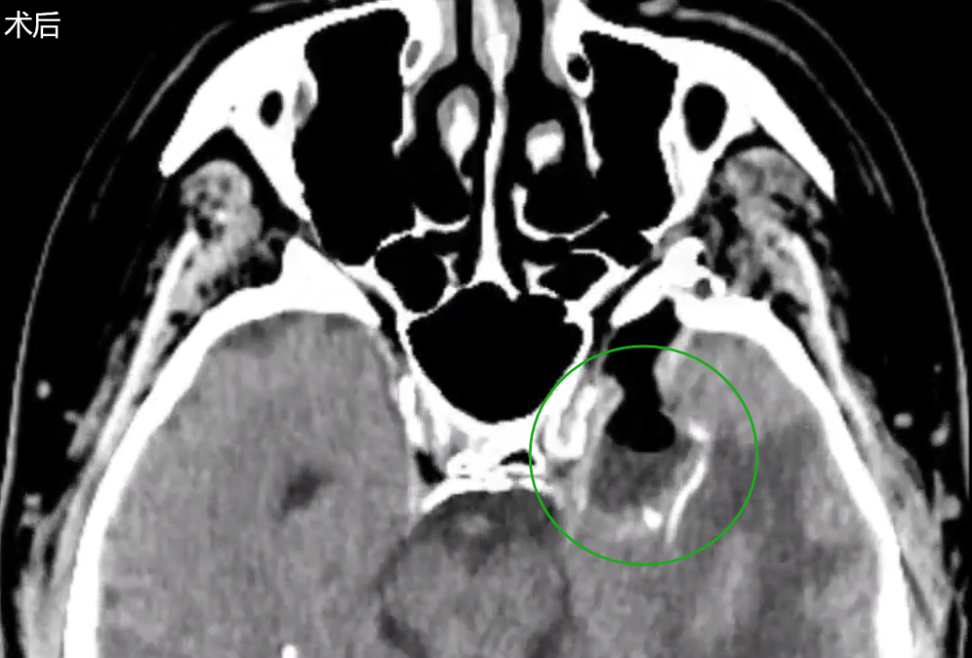 術(shù)后MRI
