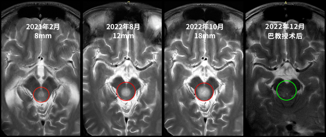 21歲的張遠(yuǎn)2021年確診中腦頂蓋腫瘤（8mm），因位置險要被告知無法手術(shù)；至2022年腫瘤快速增長至18mm并引發(fā)嚴(yán)重神經(jīng)癥狀，最終由巴教授成功完成近全切手術(shù)，病理證實(shí)為2級多形性黃色星形細(xì)胞瘤，術(shù)后功能完好