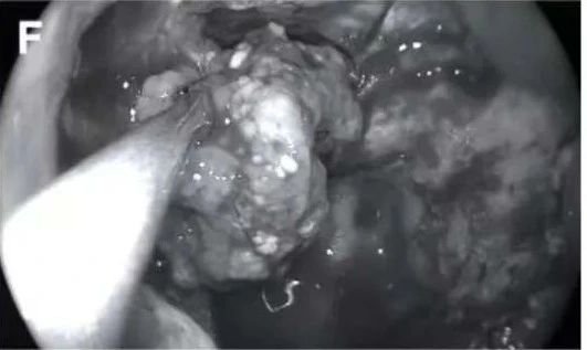 大塊腫瘤切除