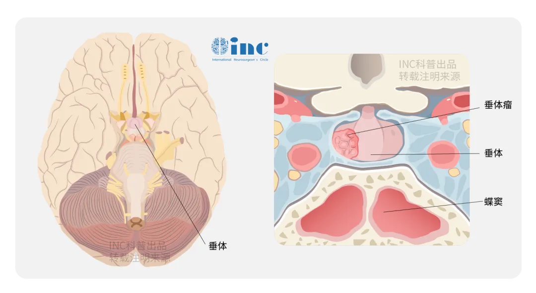 腦垂體腫瘤診療：國際垂體瘤專家的精準(zhǔn)治療
